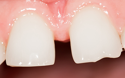 Teeth with gap in front